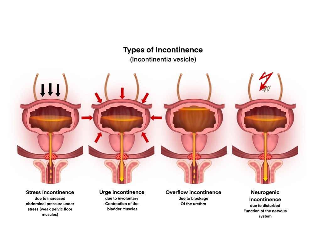 Positional Incontinance Female Incontinence Treatment in Surat - Dhameliya Kidney Hospital